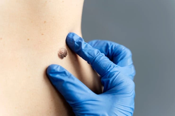 Skin Tags Facial Treatment